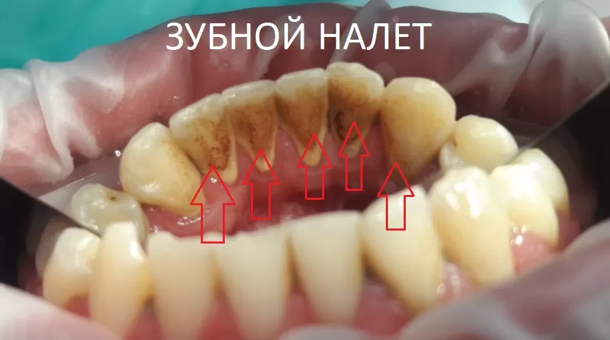 Потихоньку зуб зарастает мягкими и твердым зубным налетом